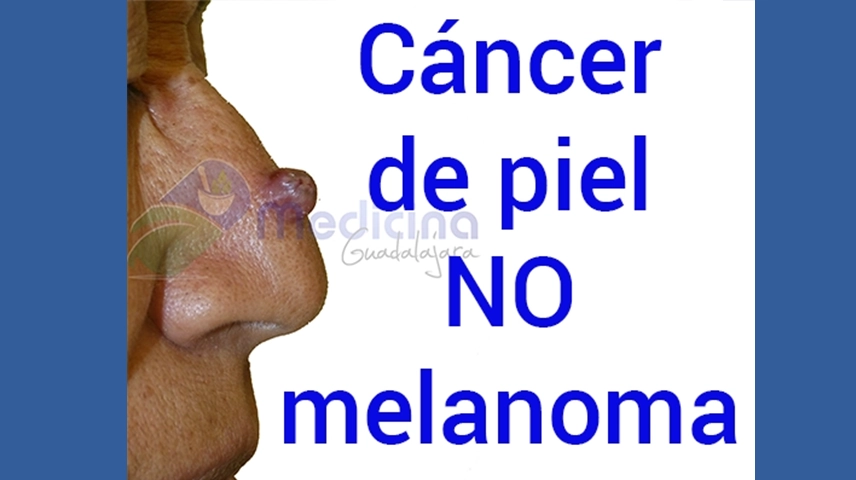 Guía completa cancer de piel no melanoma Guadalajara Jalisco México 